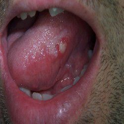 Comment se débarrasser des ulcères de la bouche