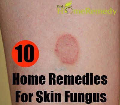 10 remèdes à la maison pour la mycose de la peau