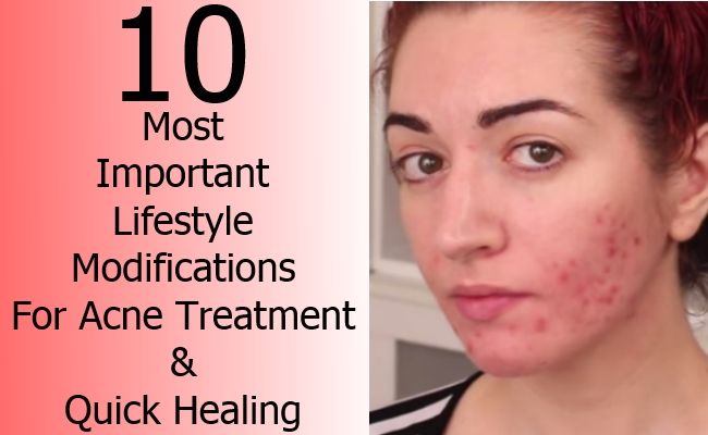 10 modifications de style de vie les plus importants pour le traitement de l'acné et la guérison rapide