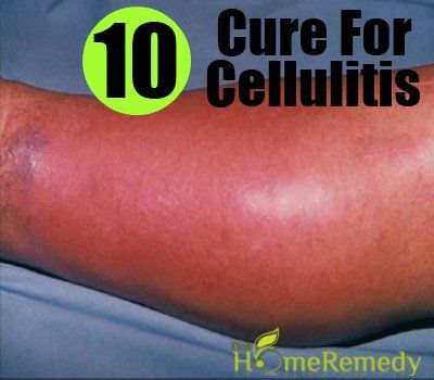 10 remède naturel pour la cellulite