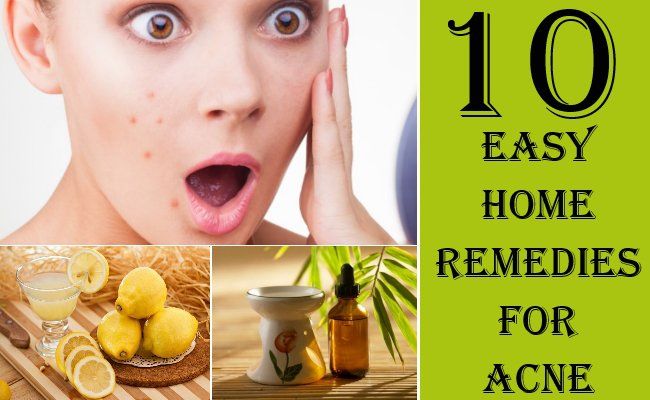 10 remèdes maison étonnamment facile pour l'acné qui fonctionnent réellement