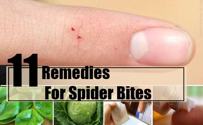 11 remèdes maison commune pour les piqûres d'araignées