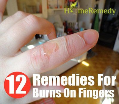 12 Accueil recours pour des brûlures sur les doigts