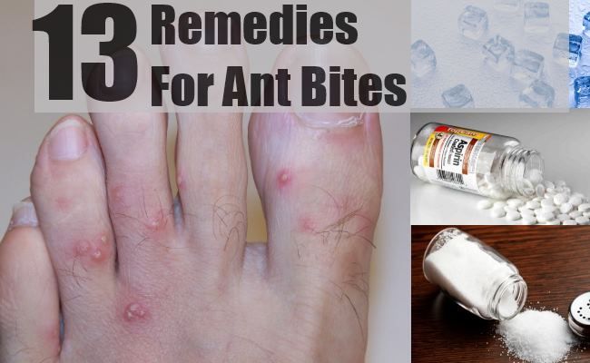 Remèdes pour Ant Bites