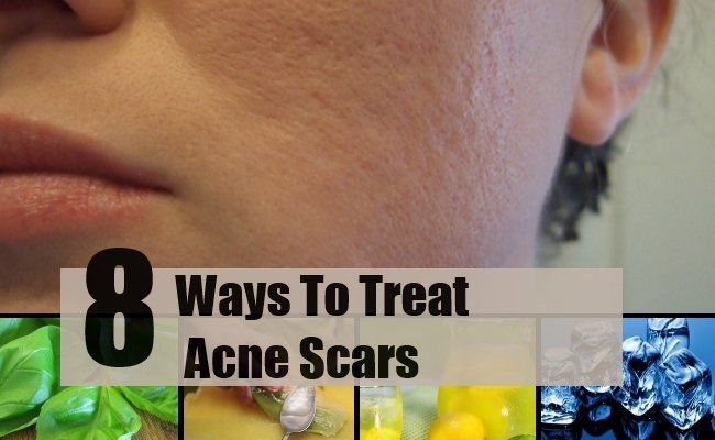 8 façons de traiter les cicatrices d'acné