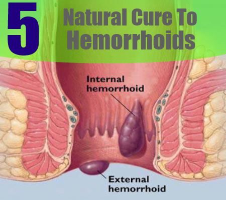5 remède naturel pour les hémorroïdes