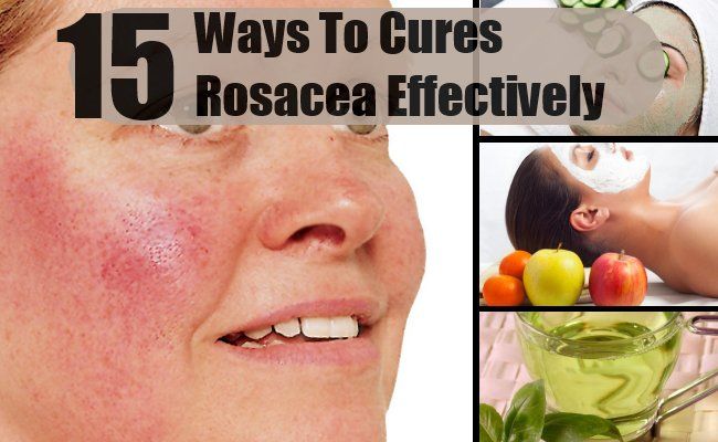 15 façons de Cures rosacée efficacement