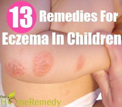 16 remèdes naturels efficaces pour l'eczéma chez les enfants