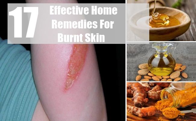 17 remèdes maison efficace pour la peau brûlée