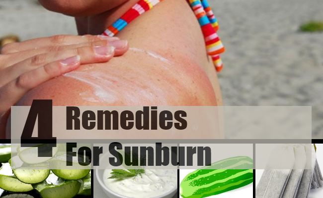 Remèdes pour Sunburn