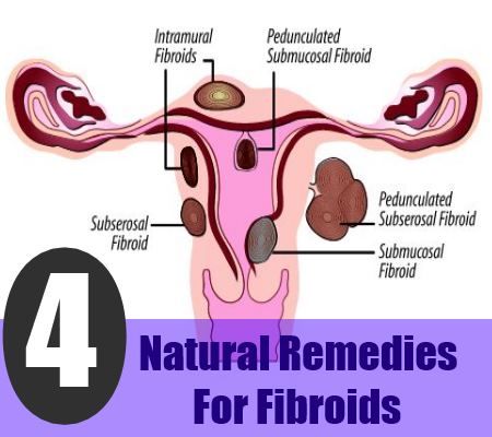4 Les remèdes naturels pour les fibromes