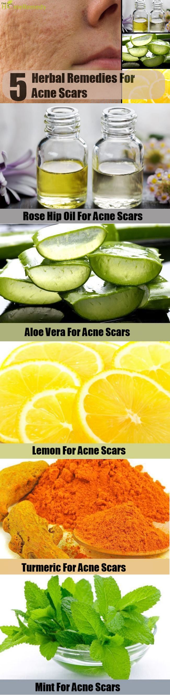5 Remèdes naturels pour les cicatrices d'acné