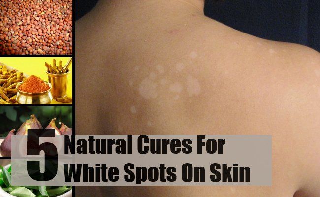 5 meilleurs remèdes naturels pour les taches blanches sur la peau