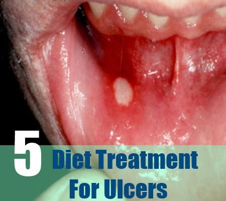 5 régime traitement pour l'ulcère