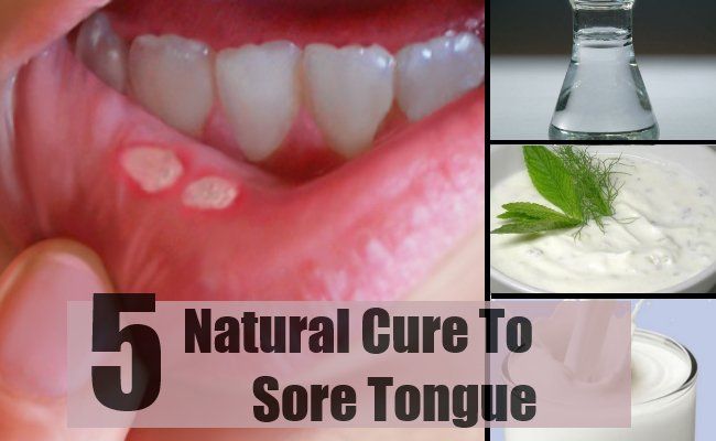 Tongue Sore