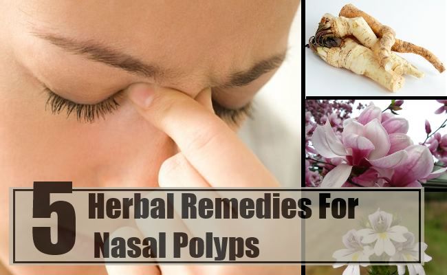 5 remèdes à base de plantes pour les polypes nasaux