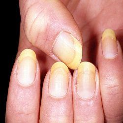 Remèdes naturels efficaces pour les ongles jaunes