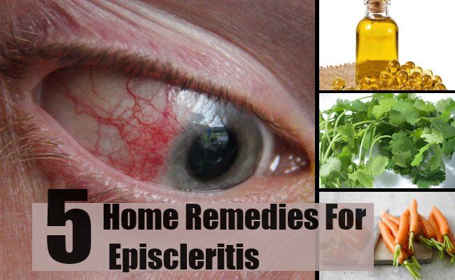 5 Accueil recours pour episcleritis