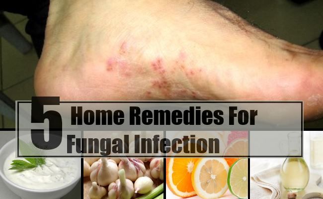 5 remèdes maison pour les infections fongiques