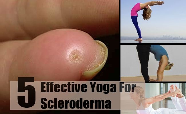 5 yoga le plus efficace pour la sclérodermie