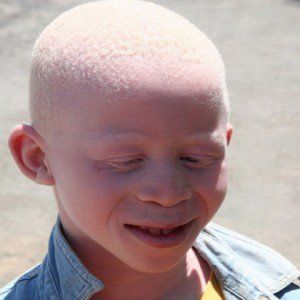 Albinisme