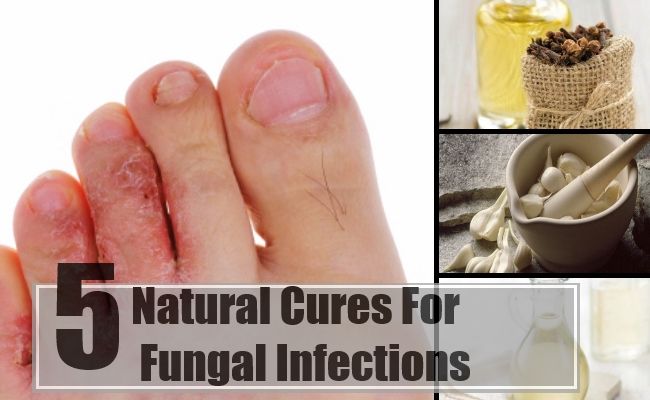 5 remèdes naturels pour les infections fongiques