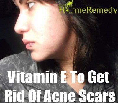 La vitamine e pour se débarrasser des cicatrices d'acné