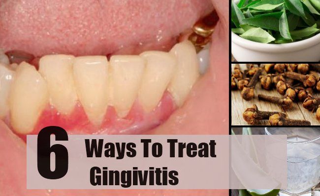 6 façons de traiter la gingivite