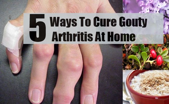 5 façons de guérir l'arthrite goutteuse à la maison
