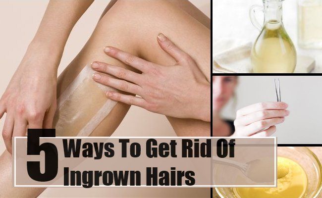 5 façons de se débarrasser des poils incarnés