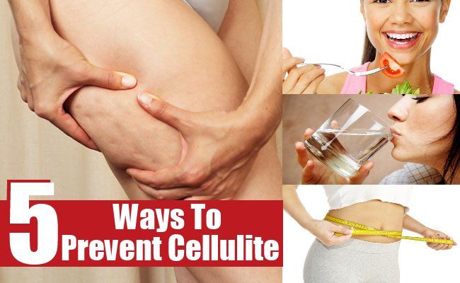 Des moyens de prévenir la cellulite