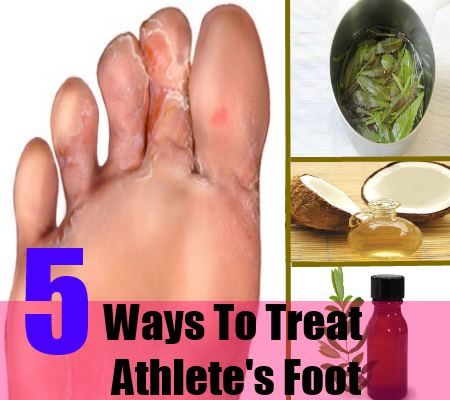5 façons de traiter le pied d'athlète