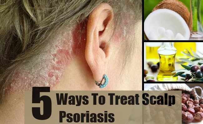 5 façons de traiter psoriasis du cuir chevelu