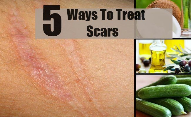 5 façons de traiter les cicatrices