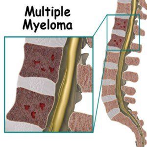 6 remèdes efficaces pour le myélome multiple