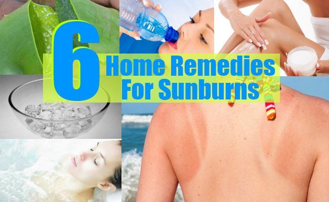 6 remèdes efficaces à domicile pour les coups de soleil