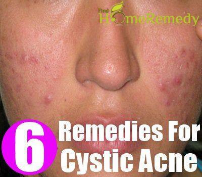 6 remèdes à base de plantes pour l'acné kystique
