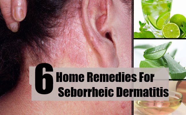 6 Accueil recours pour la dermatite séborrhéique