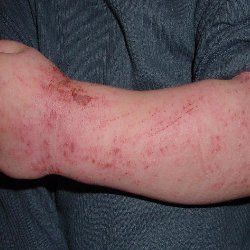 Comment faire pour guérir la dermatite