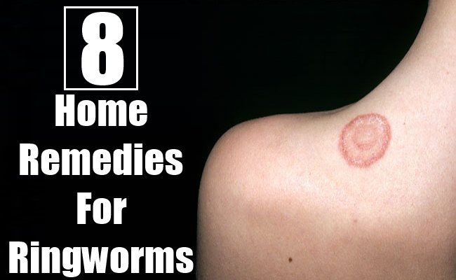 Remèdes maison pour Ringworms