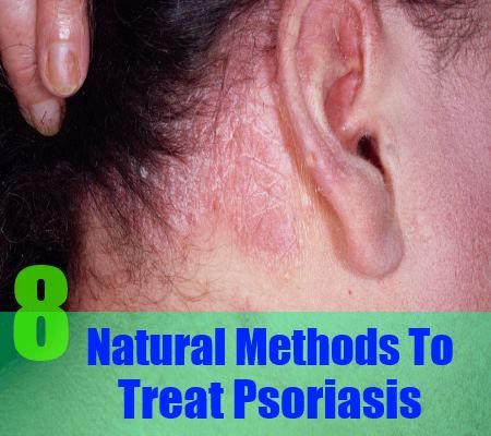 8 méthodes naturelles apaisantes pour traiter le psoriasis