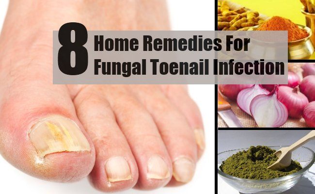 8 précieux remèdes maison pour une infection fongique des ongles