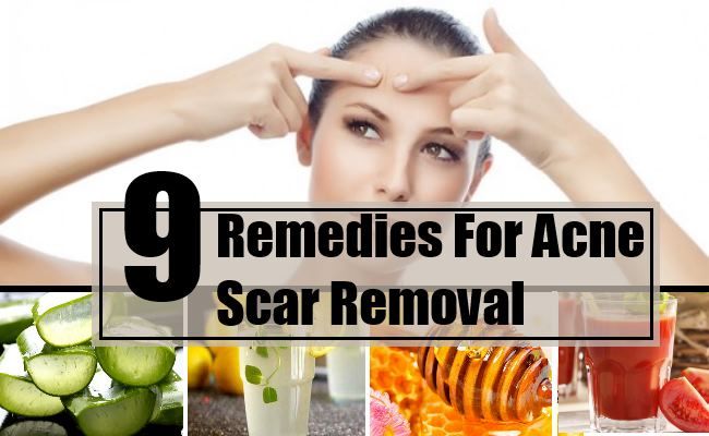 9 Les remèdes maison pour l'enlèvement des cicatrices d'acné