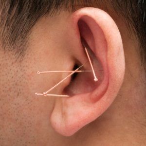 Points d'acupuncture de l'oreille