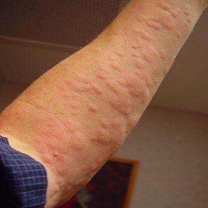 Allergique à la biotine