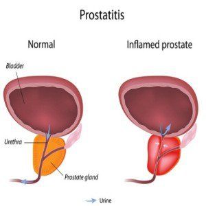 Meilleurs remèdes à base de plantes pour la prostatite