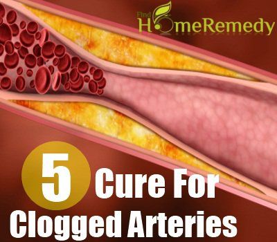 5 remède naturel pour les artères obstruées