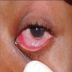 Les meilleurs remèdes naturels pour infection de l'oeil
