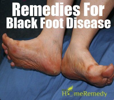 Meilleurs remèdes pour la maladie du pied noir