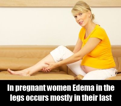 Des signes d'oedème chez les femmes enceintes